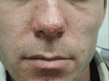 Tuberous sclerosis, angiofibromas - face: MedlinePlus ...