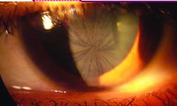 Eye showing Cornea whorling